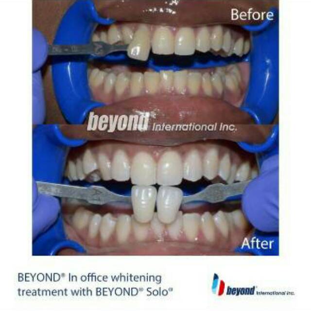 Alice dental Beyond solo / bahan bleaching gigi / teeth whitening / pemutih gigi