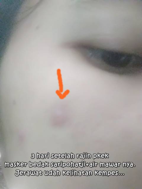 Bedak Saripohatji Masker Jerawat Shopee Indonesia