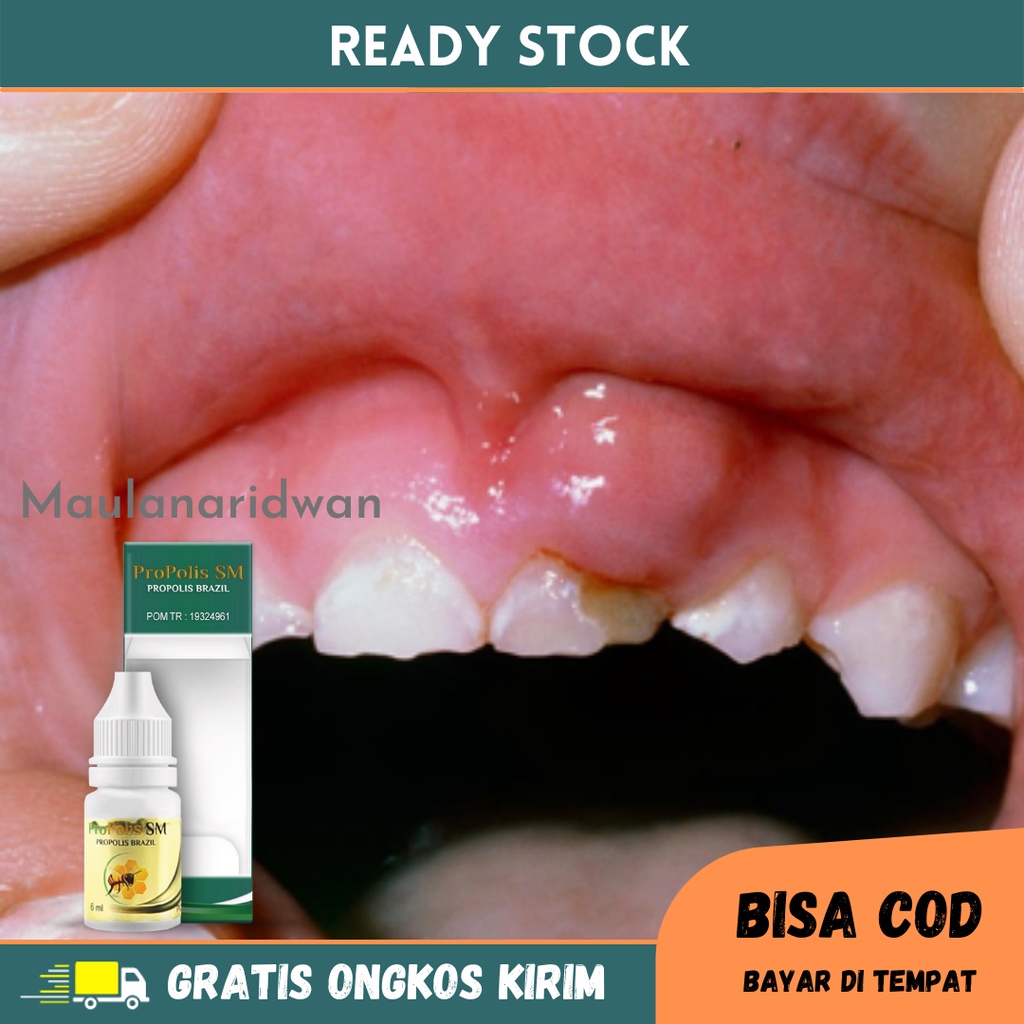 Obat Benjolan Di Gusi, Obat Abses Gusi, Obat Gusi Berdarah, Obat Gusi Bengkak, Obat Sakit Gusi, Obat