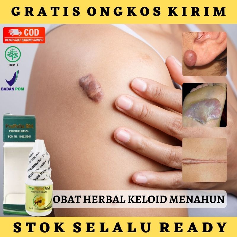 (BISA COD) Obat Alami Untuk Menghilangkan Keloid - Obat Oles Penghilang Keloid di Punggung - di Lehe
