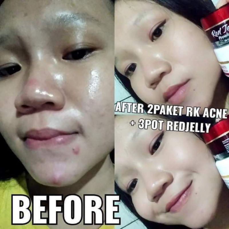 COD - RK GLOW ACNE - PAKET SKINCARE JERAWAT - MENGHILANGKAN ACNE DAN BEKASNYA - MEMBUAT MULUS