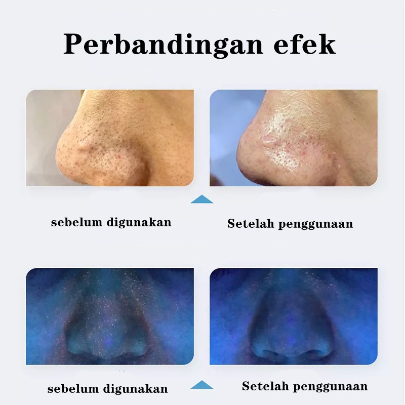 inFace Facial Alat Pembersih Komedo 40°C Suhu Konstan SPA Instrumen Perawatan Kulit Kecantikan Tiga Kepala Hisap Electric Acne Clean Blackhead Black Point Vacuum Negatif Sirkulasi Air Tekanan Wajah Penuh Aqua Peel Termal Perangkat Wajah CF-07E