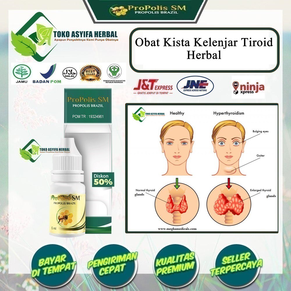 Obat Kista Kelenjar Tiroid, Kista Tiroid, Kista Getah Bening, Ada Benjolan Kista, Kelenjar Tiroid, K