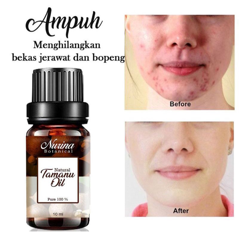 

obat jerawat herbal (tamanu oil)/acne serum ampuh /nota 2 aply