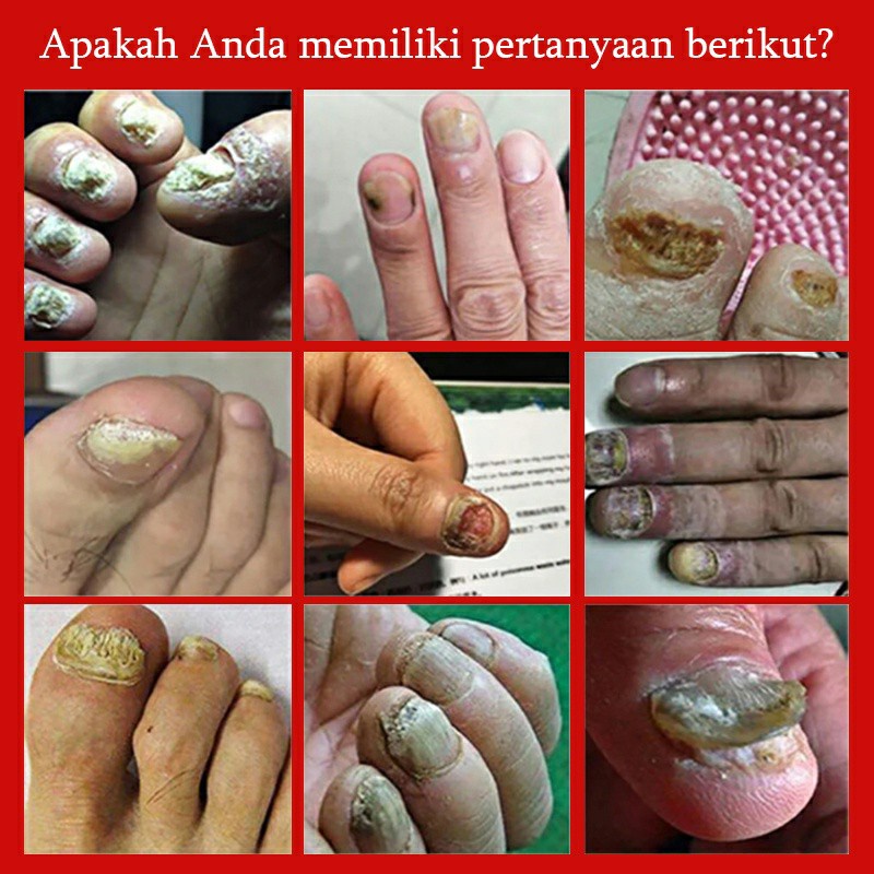 Perawatan kuku Obat jamur kuku 25ml kuku menebal / Atrofi kuku / lapisan kuku / kuku rontok / perubahan warna kuku / kuku bergelombang