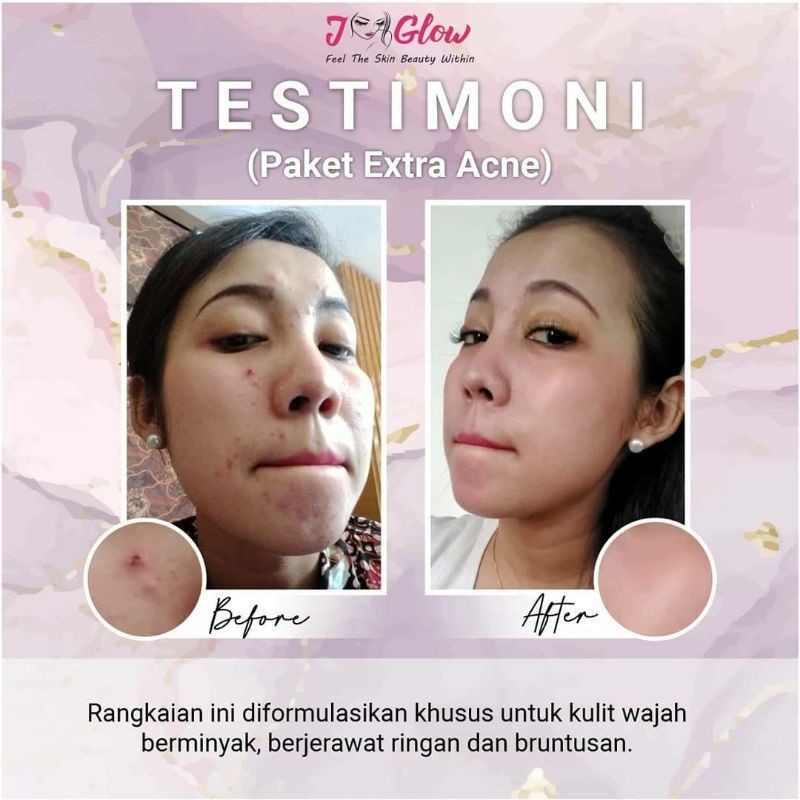 Jglow Skincare Paket Acne Sulfur Whitening Cream Skin glowing Perawatan Wajah Jerawat Meradang Bpom-8