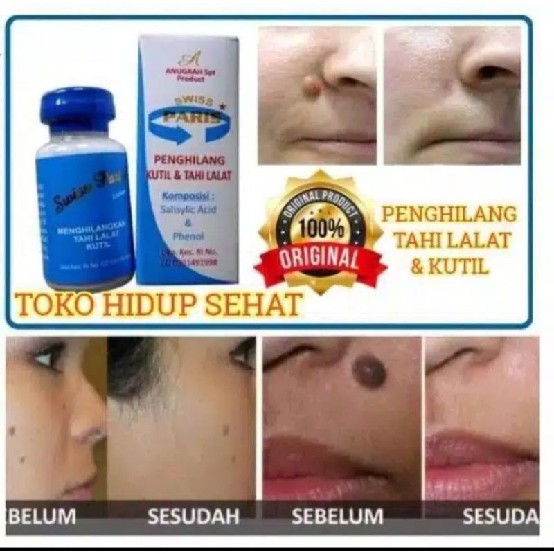 PENGHILANG TAHI LALAT AMPUH CEPAT TANPA OPERASI SWISS PARIS