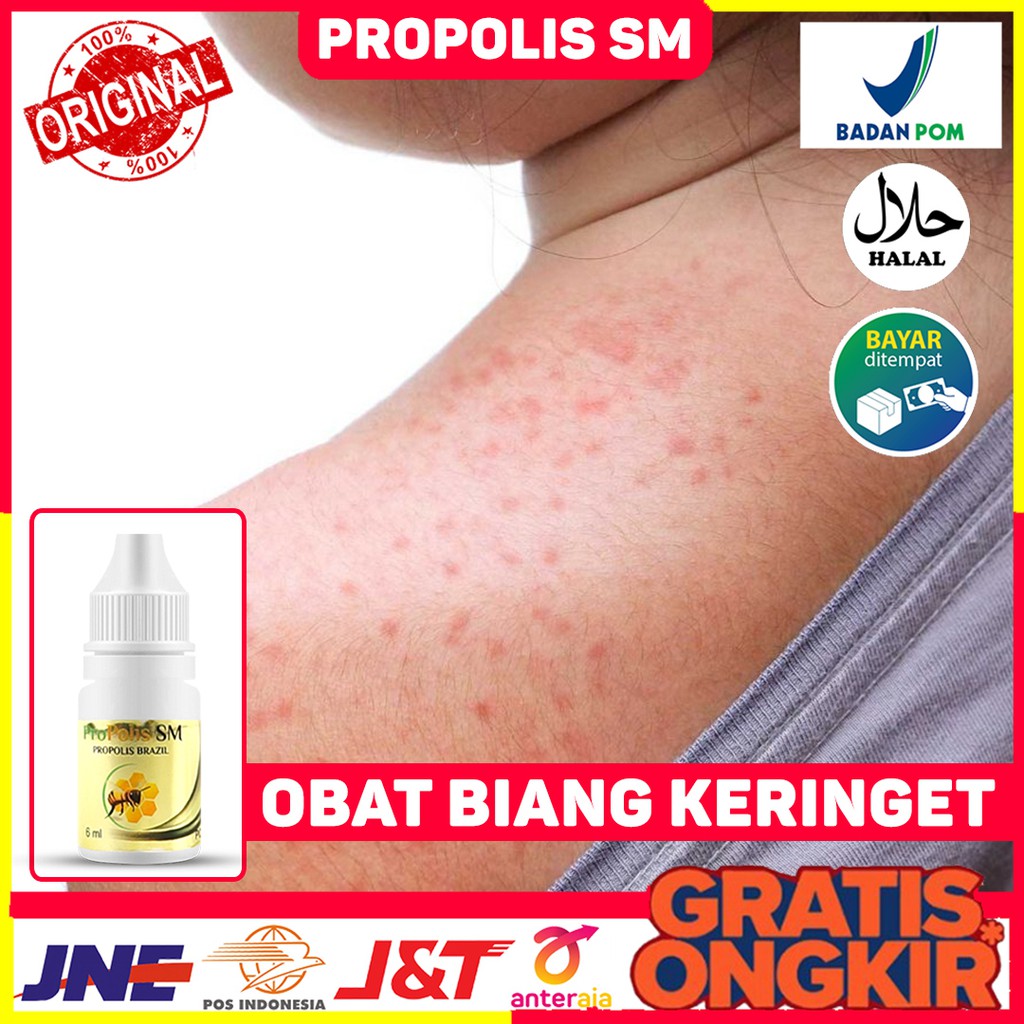 Jual Obat Biang Keringat Obat Miliaria Rubra Obat Bintik Bintik Merah Obat Kulit Gatal Gatal