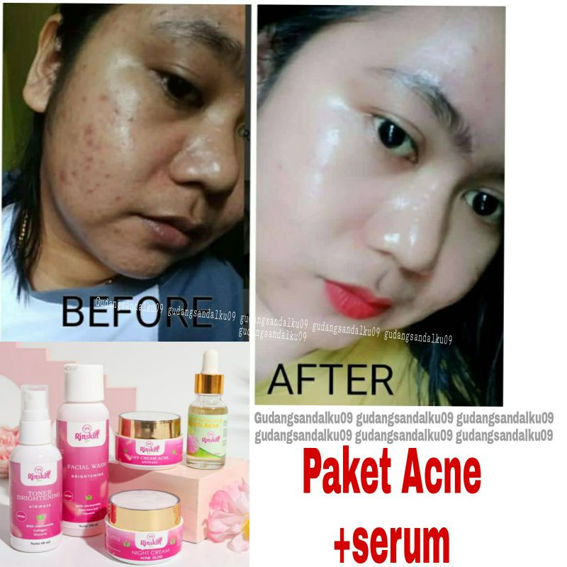 CREAM WAJAH BERJERAWAT BRUNTUSAN MILEA - NR GLOW ACNE BPOM - SERUM JERAWAT AMPUH