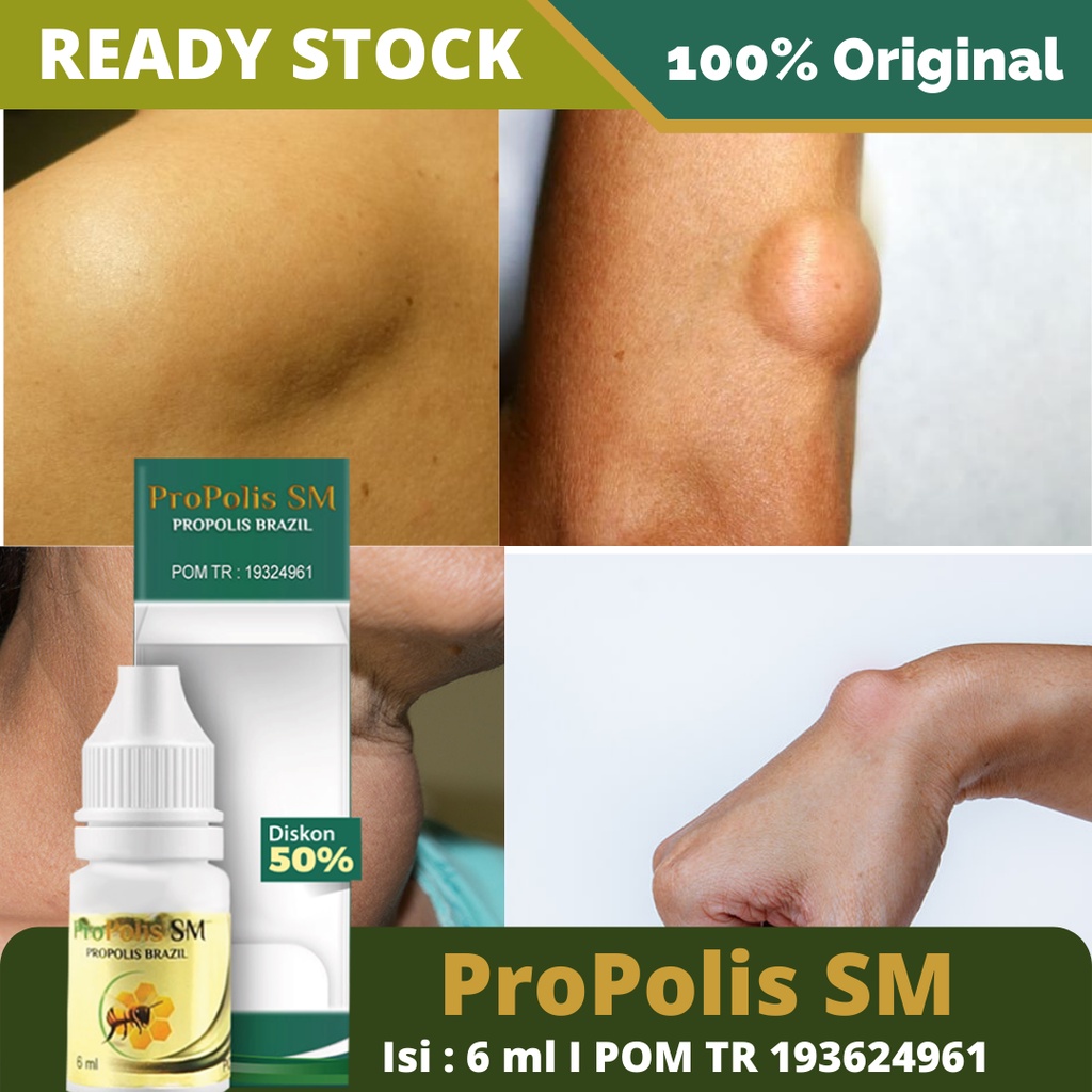 Obat Penghilang Benjolan Ditubuh, Lipoma, Uci, Tiroid, Benjolan Abnormal, Benjolan Ditangan, Benjolan Dikaki, Benjolan Di Punggung, Benjolan Dijidat, Benjolan Dikaki, Kelenjar Getah Bening – ProPolis SM Brazil 100% Original BPOM