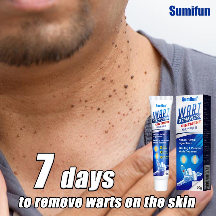 Sumifun Wart Removal Cream Skin Tag Remover 20g - Menghilangkan Kutil Tahi Lalat Mata Ikan Penghilang Tahi Lalat