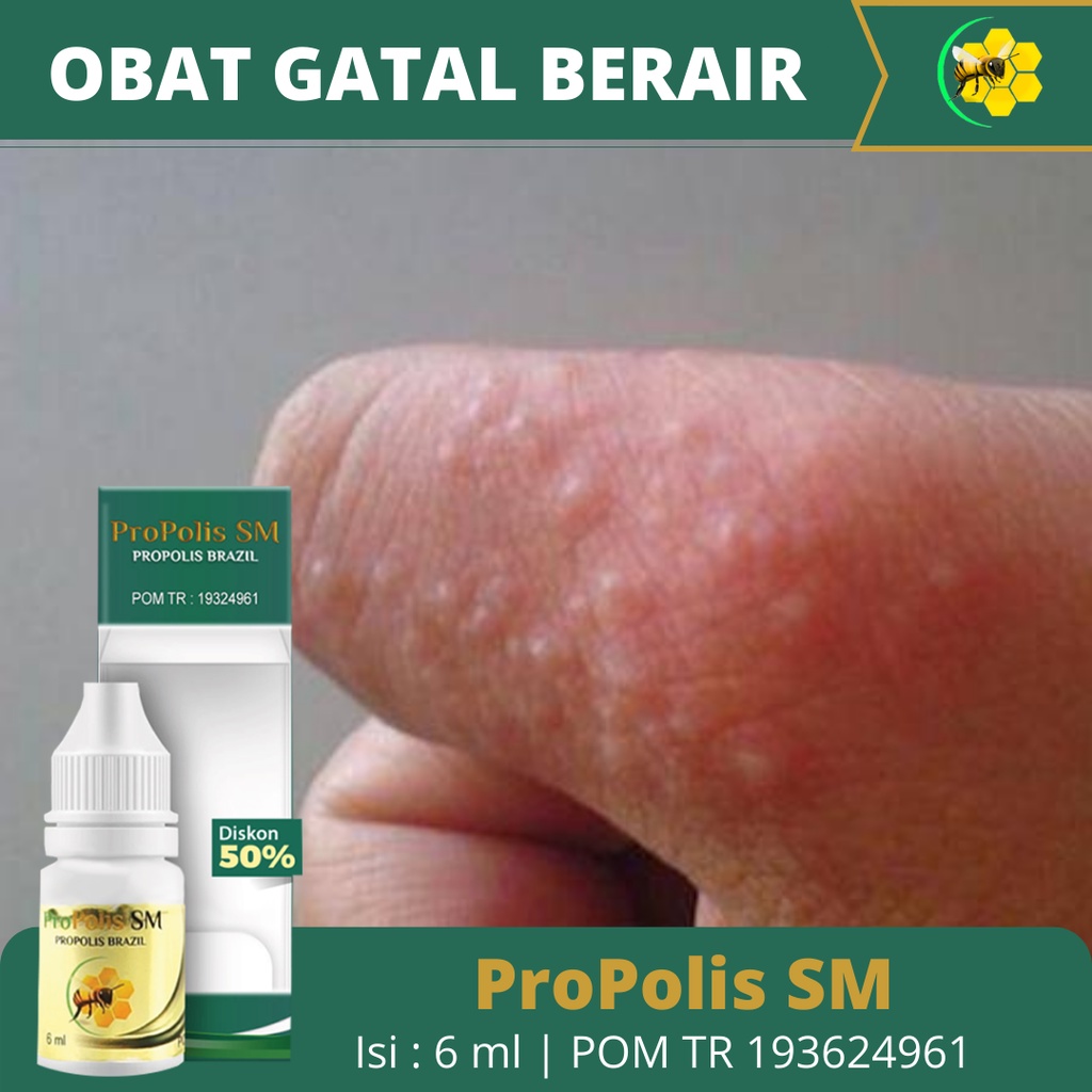 Obat Gatal Berair Di Jari Tangan Dan Kaki, Obat Gatal Bintik Berair, Obat Oles Kulit Gatal, Obat Bin