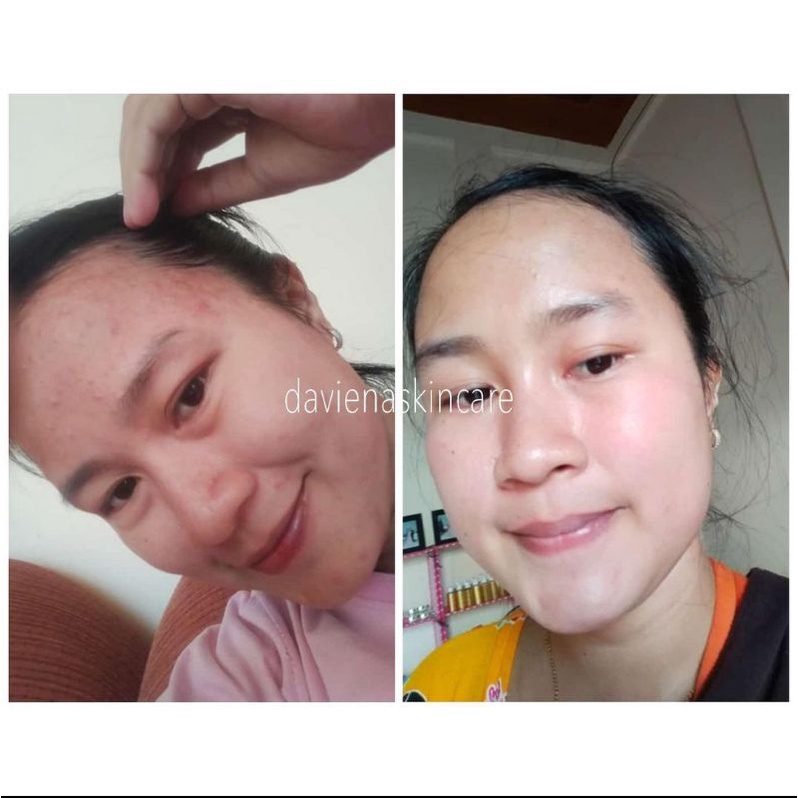 Daviena Skincare Paket Gold Series Davienaskincareofficial Davina Devina Lampung Surabaya Jakarta Pencerah Pemutih Flek Wajah Glowing Bpom Daviena Skincare-2