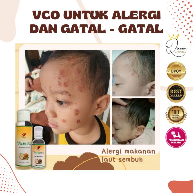 COD/ Minyak VCO Untuk Bayi / Ampuh Obat Gatal-Gatal Bayi / Ruam Popok / Bruntusan / Obat Alergi / Minyak Kelapa untuk gatal - gatal / Obat Gatal Herbal / Obat Biang Keringat Bayi / Obat Biang keringat Anak