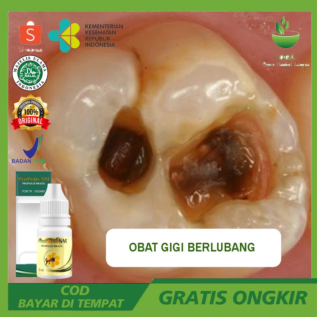 Obat Bau Mulut Karena Gigi Berlubang, Gigi Berlubang Bengkak, Gigi Berlubang Berdenyut, Gusi Bengkak