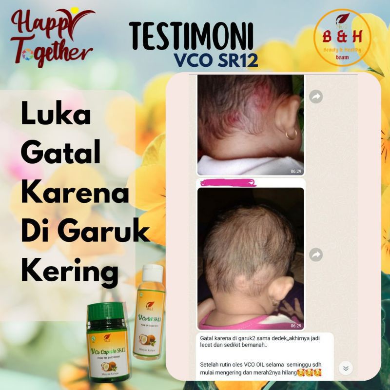 VCO SR12 Untuk Ruam Popok / Minyak Bayi / Biang Keringat / Minyak Kelapa Untuk Bayi / Obat Eksim Bruntusan Dermatitis Kulit Berkerak Bayi Anak