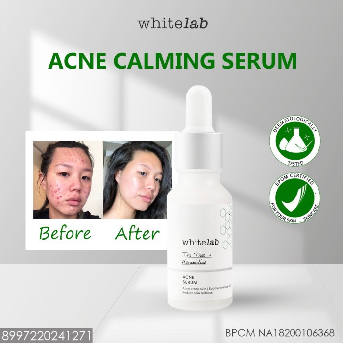 Whitelab WL Acne Calming Serum menghilangkan jerawat