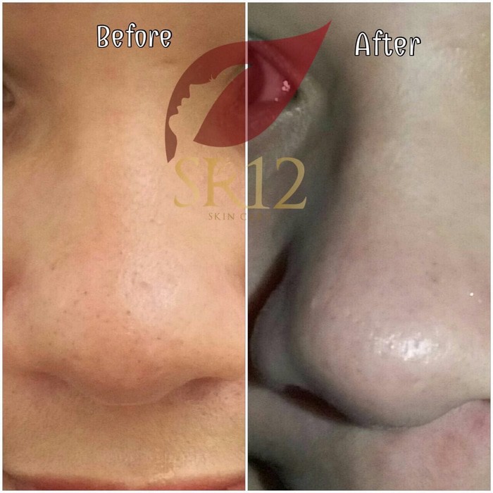 BHA 30% ACNE SCAR PEELING masker serum aha 8 10 neostrata naavagreen