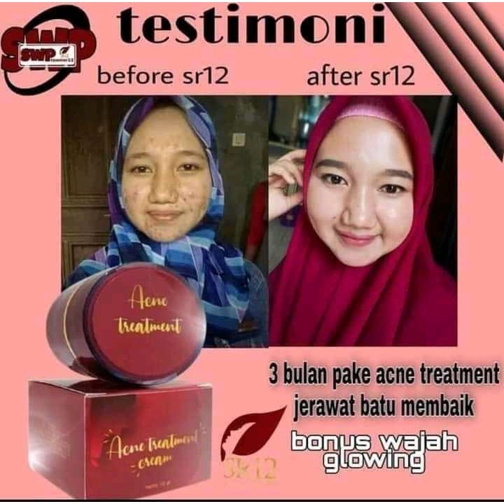 Acne Treatment Cream SR12 Penghilang Noda Bekas Jerawat Luka Stretch Mark