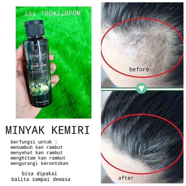 PENGHILANG KETOMBE KUNTZE MINYAK KEMIRI HITAM ORIGINAL BPOM 100ML