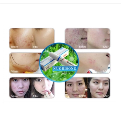 Nuobisong Obat Penghilang Bekas Luka /Jerawat / Selulit Scar Gel