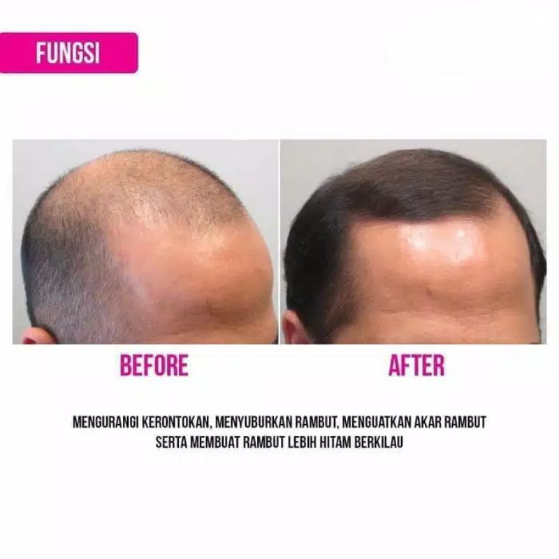 Penumbuh Rambut Botak Penyubur Rontok Untuk Wanita Pria Alami Cepat BMKS Hair Tonic Kemiri BPOM