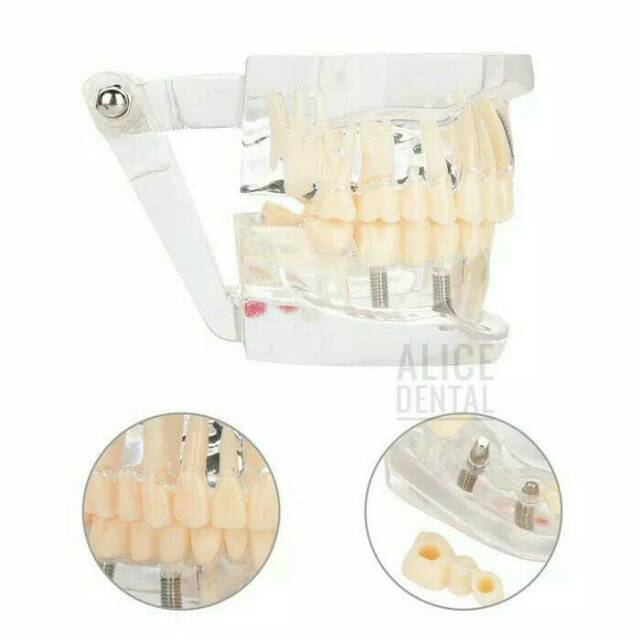 Model study gigi edukasi transparan studi implant phantom crown karies bridge bening impaksi model gigi bisa dilepas typodont ALICE DENTAL