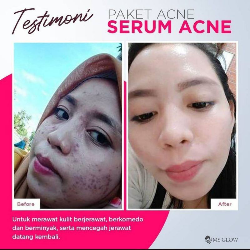 MS GLOW Paket Free Bonus Pouch/Dompet Kosmetik/Ecer Whitening Night Cream/Luminous/Malam Ultimate/Krim Siang/Facial Wash Msglow/Toner Acne/Glowing/Sabun Men/Day/Man Basic/Serum Gold/Peeling/JJ Glow/DTE/Underarm/Red Jelly/Radiance Gel/Scrub Original Asli