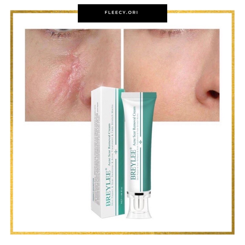 Breylee Penghilang Bekas Luka Jerawat Strechmark Acne Scar Original Shopee Indonesia
