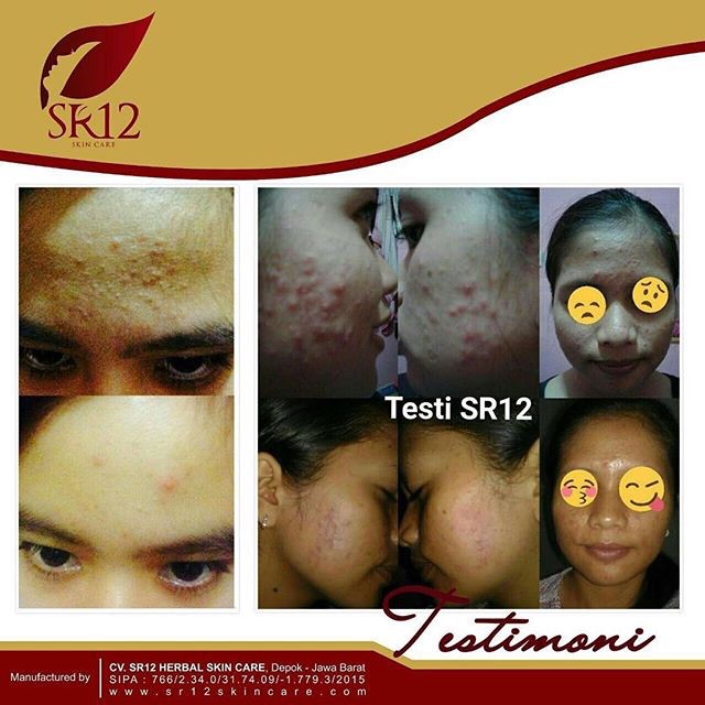 SR12 ACNE TREATMENT CREAM KRIM JERAWAT MERADANG &amp; MEMBANDEL AMPUH HILANGKAN JERAWAT