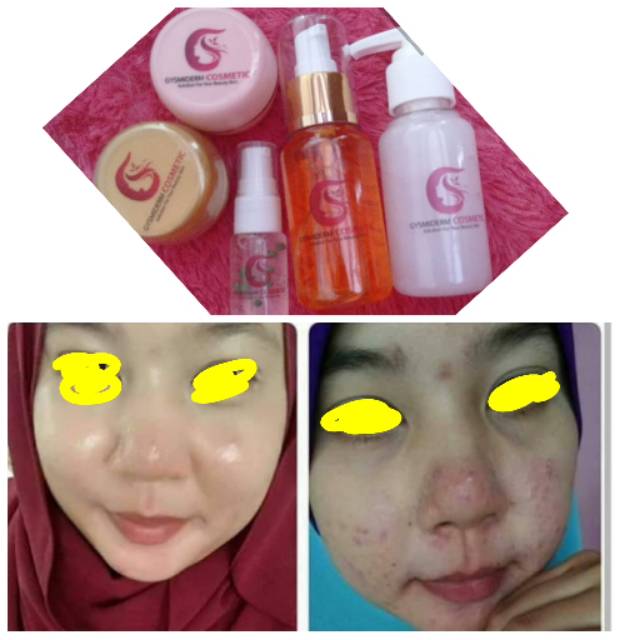Paket acne Gysmiderm