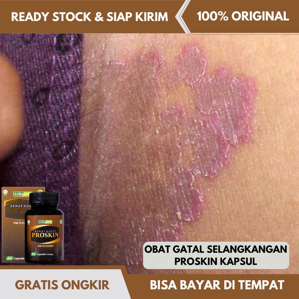 Jual Obat Gatal Selangkangan Obat Salep Gatal Kulit Obat Gatal Jamur