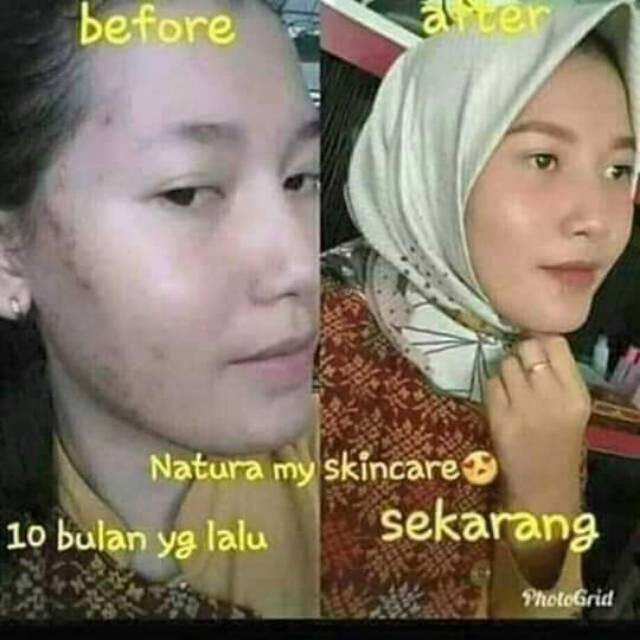 Natura Beauty Spray Serum Penghilang jerawat