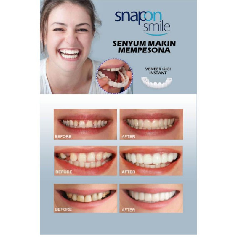 snap on smile