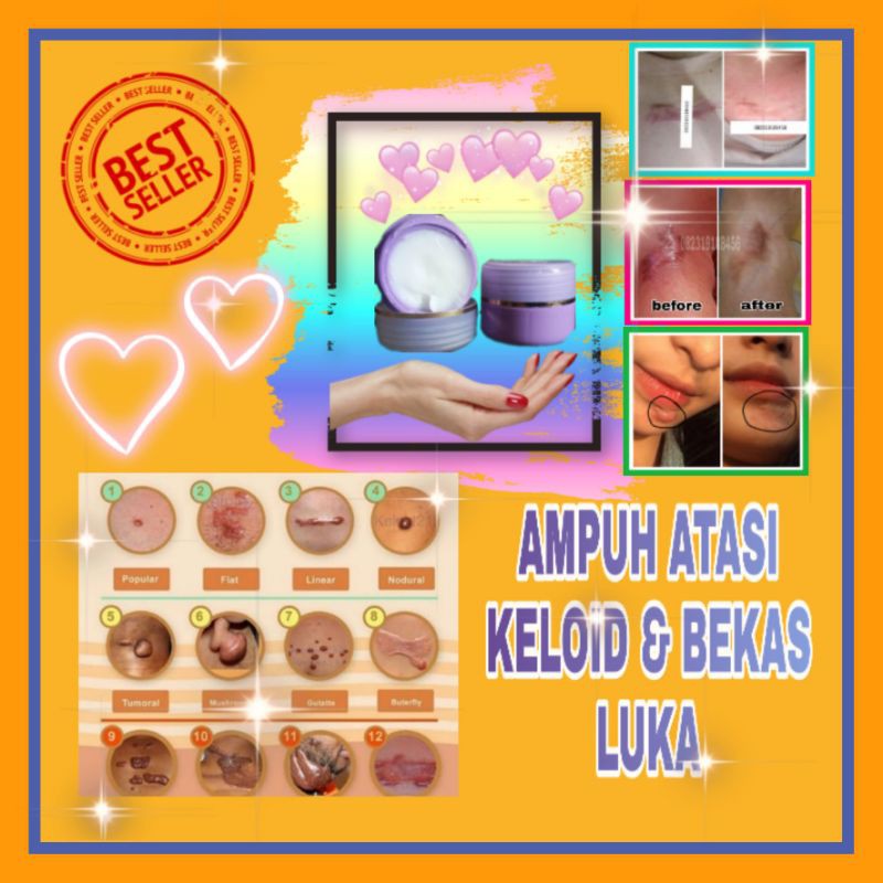 CREAM KELOID & BEKAS LUKA
