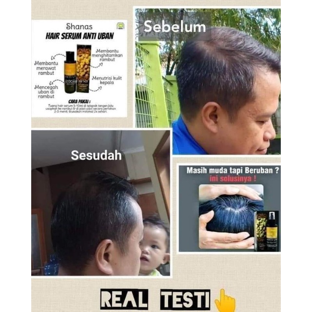hair serum anti uban