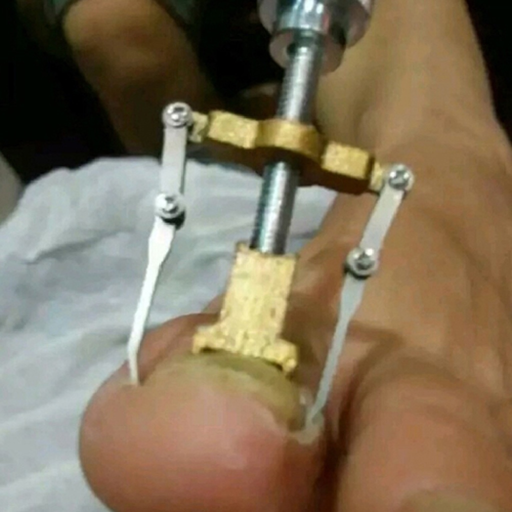 (LIKE) Alat Koreksi Kuku Kaki Tumbuh Kedalam Profesional Untuk Pedicure