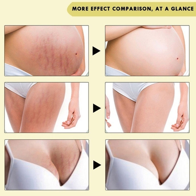 Rtopr Stretch Mark Cream  - Penghilang Strech Mark / Bekas Luka Ampuh Oermanen bpom Krim Stretch Mark