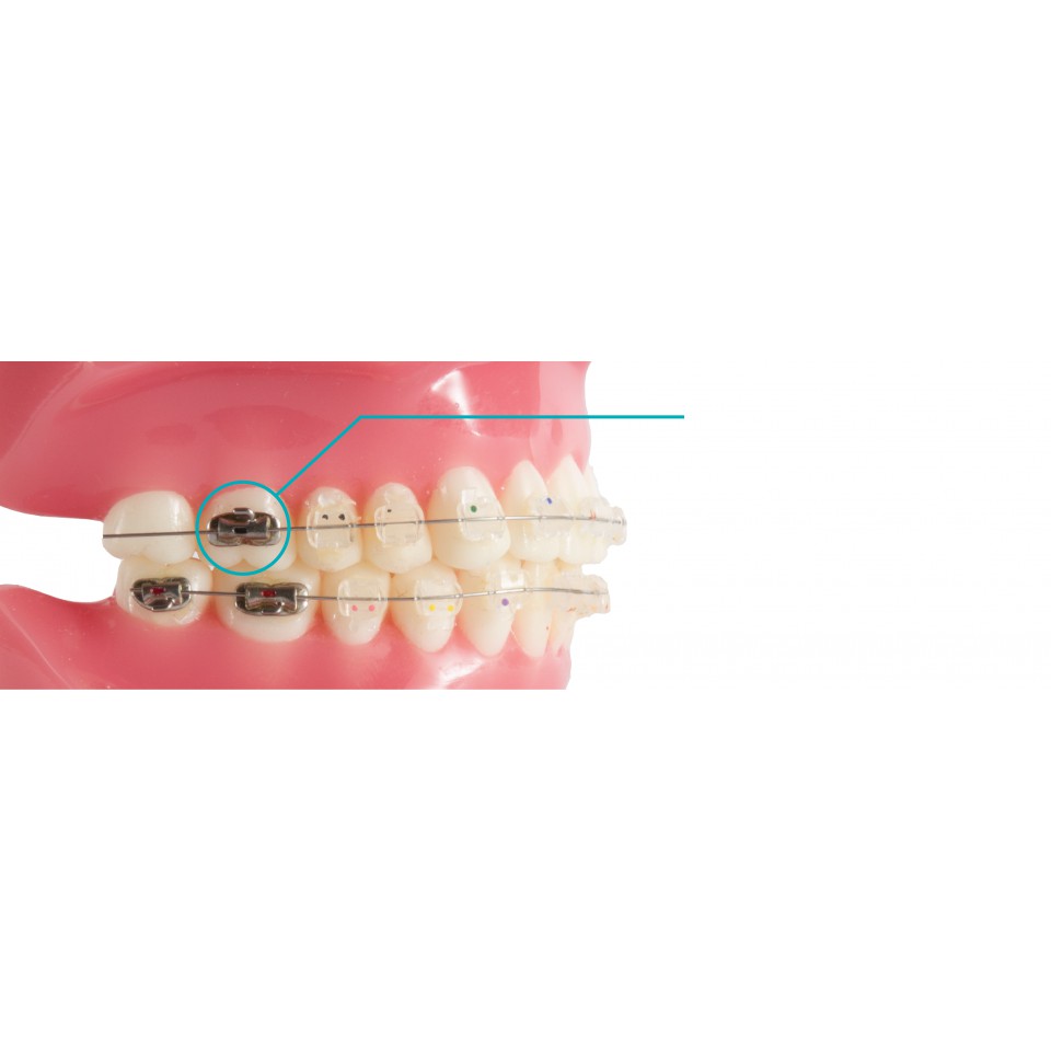 Behelldental Buccal Tube Bracket Pengunci Gigi Geraham Buccaltube kunci behel Molar Band M1 M2 isi 4