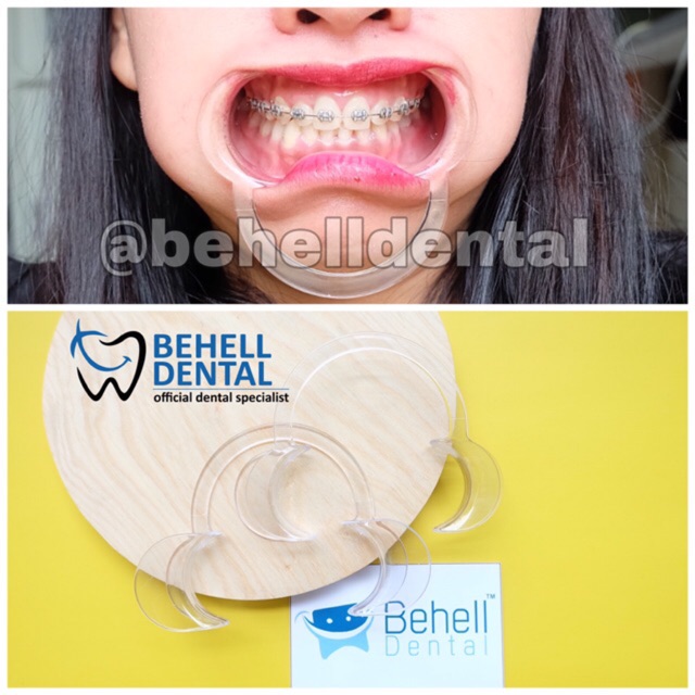 Cheek Retractor bening Pembuka Mulut / Mouthgate / Dental penyangga gigi saat memasang bracket behel