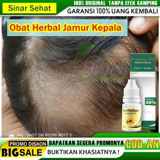 Obat Jamur Di Kepala, Obat Kulit Kepala Berjamur, Obat Kulit Kepala Borok