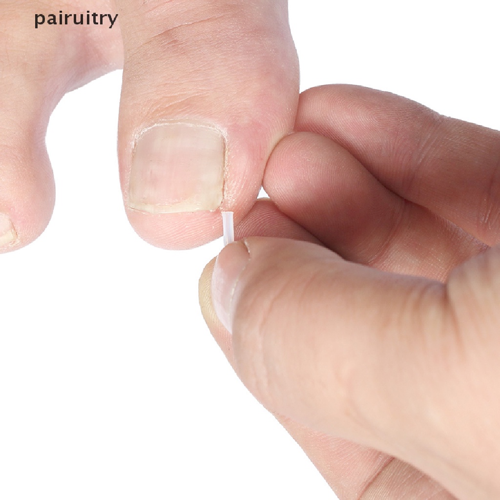 Prt 10pcs Pad Koreksi Kuku Kaki Ingrown Ortopedi PRT