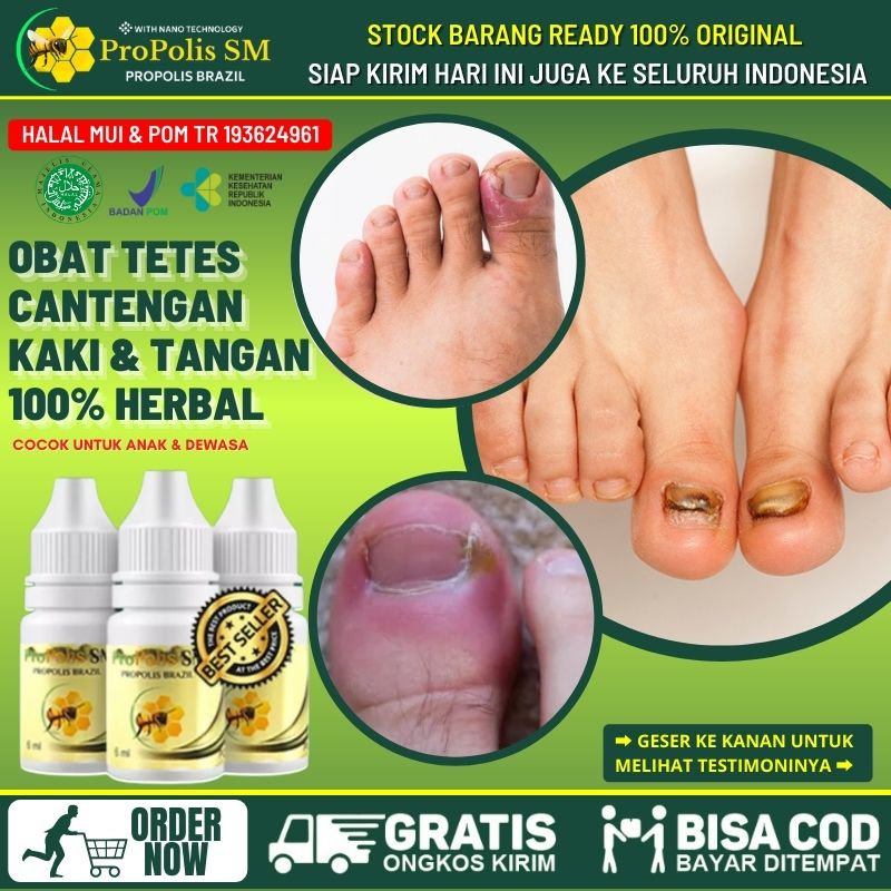 Obat Cantengan Kaki, Obat Kuku Kaki Cantengan, Obat Tetes Kuku Tangan Cantengan, Obat Cantengan Yang