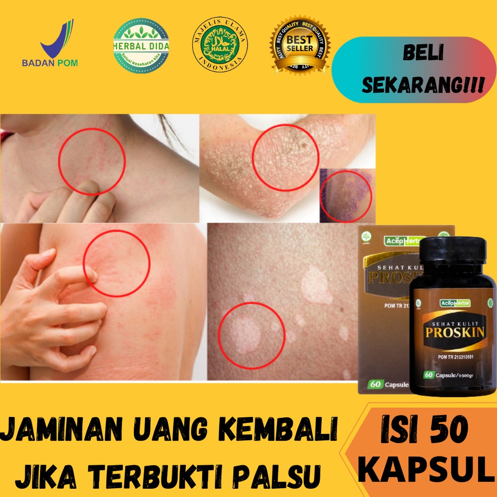 Obat Herbal Mengatasi Kulit Gatal Gatel, Obat gatal kulit eksim, Obat Ruam Jamur Kudis Kurap, Obat g