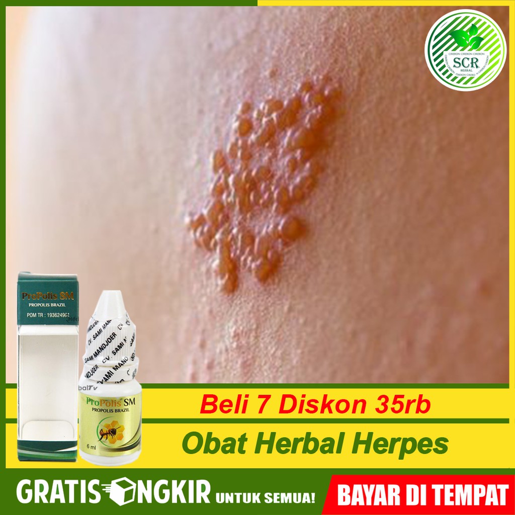 

Obat Herpes, Herpes Di Bibir, Kulit Kepala Gatal, Ketombe Herbal Propolis SM Di Cirebon Bisa COD