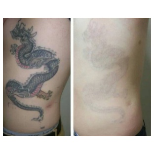 ORIGINAL Tatonox Penghilang Tato Permanen terbaik / Tattonox / Tatto