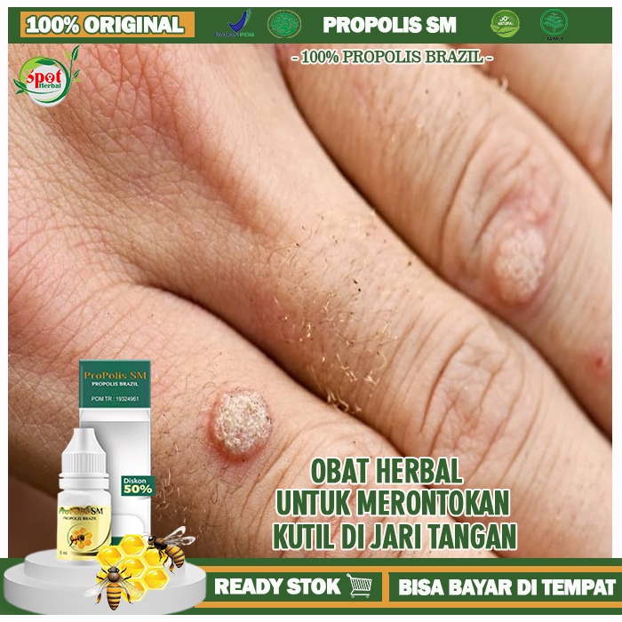 Obat Perontok Kutil Di Jari Tangan, Obat Oles Penghilang Kutil Di Tangan, Obat Kutil Di Tangan,  Oba