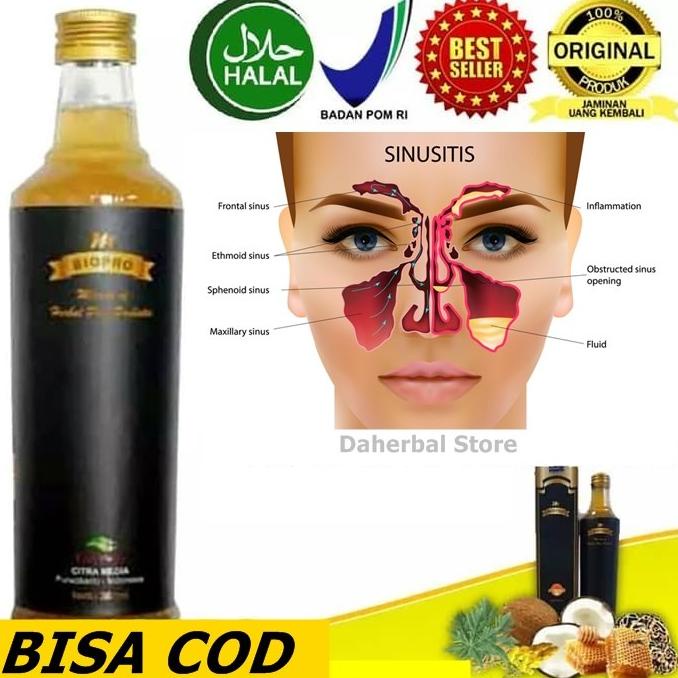 

TERLARIS Obat Sinus Herbal - Sinusitis Akut Kronis - Hidung Bau Busuk /OBAT HERBAL ASAM URAT/OBAT HERBAL PELANGSING/OBAT HERBAL KOLESTEROL/OBAT HERBAL DIABETES