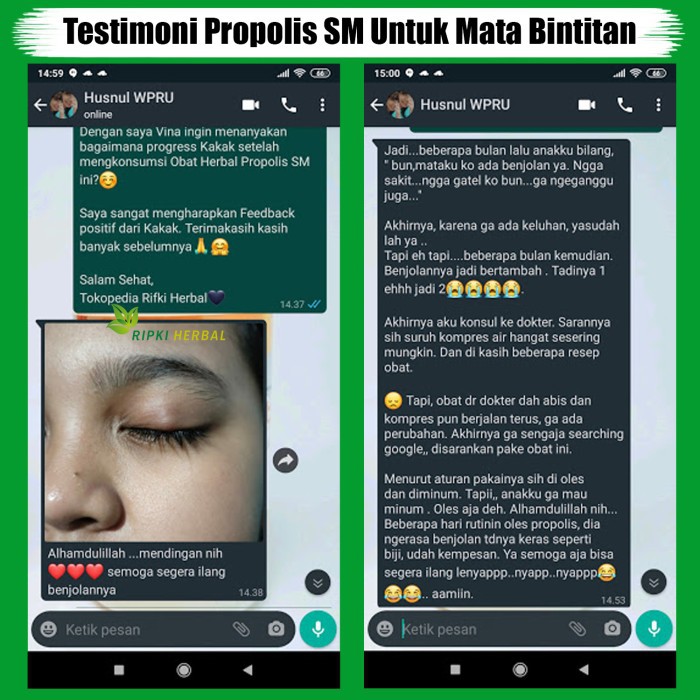 Obat Mata Kalazion - Obat Alami Untuk Bintitan Mata Menahun - Obat Benjolan di Kelopak Mata - Obat Mata Bintit Pada Anak dan Dewasa - Obat Mata Bintitan - Obat Penghilang Benjolan Kecil di Mata - Salep Pengecil Mata Bintitan Dengan Propolis SM 100% ASLI