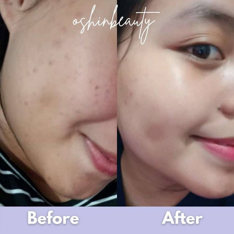 Oshin Beauty | Oshinbeauty | Paket Acne Series | Paket Glow Series | Ecer/Satuan BPOM